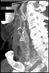 Diseased Carotid Artery Without Stenosis - CTisus CT Scan