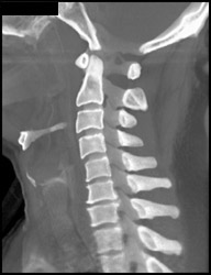 Degenerative Joint Disease (DJD) Spine - CTisus CT Scan