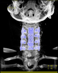 Post Cervical Fusion - CTisus CT Scan