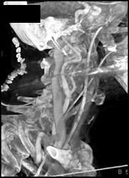 Normal Carotid Artery - CTisus CT Scan