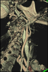 Normal Carotid Artery - CTisus CT Scan