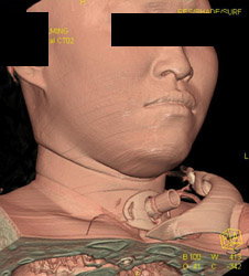 Tracheostomy - CTisus CT Scan