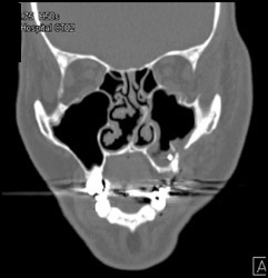 Maxillary Fracture - CTisus CT Scan