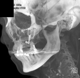 Post Orbital Fracture Repair - CTisus CT Scan