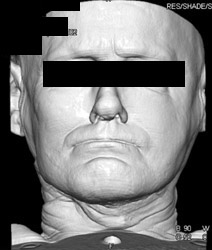 Viewing the Skin - CTisus CT Scan