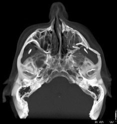 Zygomatic Arch Fracture - CTisus CT Scan