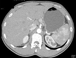 Arteriovenous Malformation (AVM) Spinal Cord - CTisus CT Scan