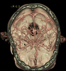 Ct Angiogram - CTisus CT Scan