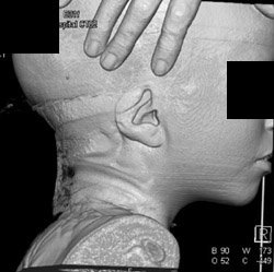 3D of the Skull - CTisus CT Scan