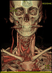 Normal Carotid Artery - CTisus CT Scan