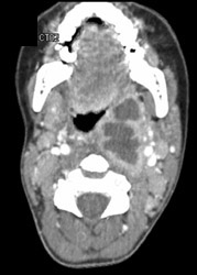 Neck Abscess - CTisus CT Scan