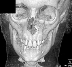 Orbital Floor Fractures - CTisus CT Scan