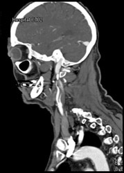 Pulmonary Embolism (PE) Without Jugular Vein Thrombosis (JVT) - CTisus CT Scan