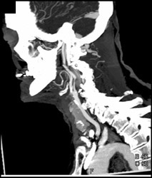 Carotid Stenosis - CTisus CT Scan