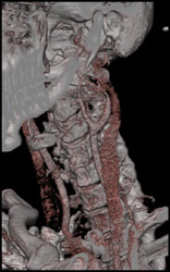 Carotid Body Tumor - CTisus CT Scan