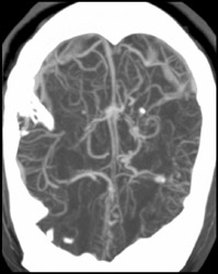 Normal CTA - CTisus CT Scan