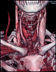 Normal Jugular Vein - CTisus CT Scan