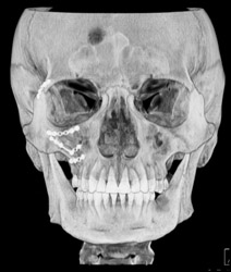 Orbital Fracture Repair - CTisus CT Scan