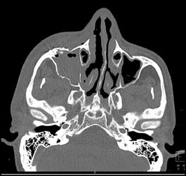 Orbital Fracture Repair With Blood in Maxillary Sinus - CTisus CT Scan