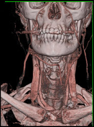 Normal Carotid Artery - CTisus CT Scan