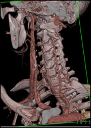 Normal Carotid Artery - CTisus CT Scan