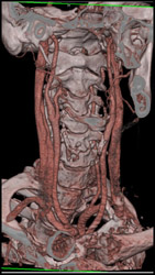 Normal Carotid Artery - CTisus CT Scan