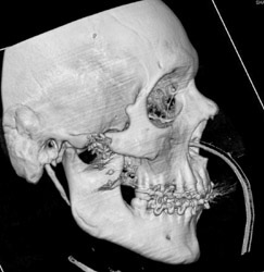 GSW to Face - CTisus CT Scan