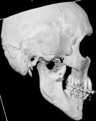 Fracture of Mandible - CTisus CT Scan