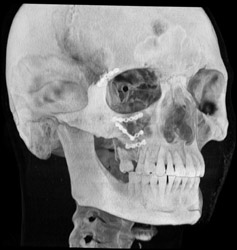 GSW Skin - CTisus CT Scan