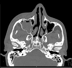 Opacified Right Maxillary Sinus - CTisus CT Scan