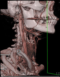 Normal Carotid Artery - CTisus CT Scan