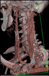 Normal Carotid Artery - CTisus CT Scan