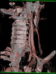 Vertebral Artery - CTisus CT Scan