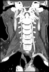 Normal Vertebral Artery - CTisus CT Scan