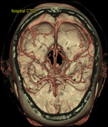 Normal Circle of Willis (COW) - CTisus CT Scan