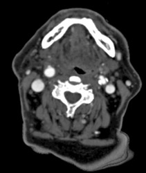 Stenosis of Left Carotid Artery - CTisus CT Scan