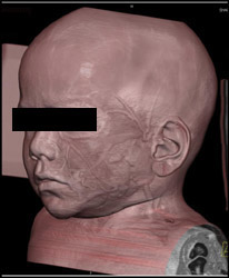 3D Brain - CTisus CT Scan