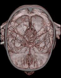 Normal Circle of Willis (COW) in Child- Same Patient in Cases 98 and 99 - CTisus CT Scan