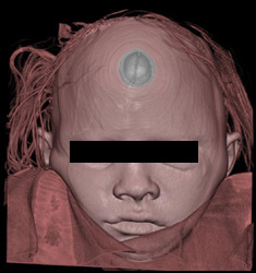 Post Repair of Orbital Fracture - CTisus CT Scan