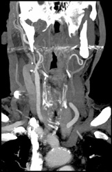 Carotid Artery Stenosis - CTisus CT Scan