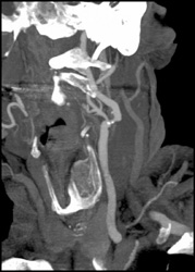 Carotid Artery Stenosis - CTisus CT Scan