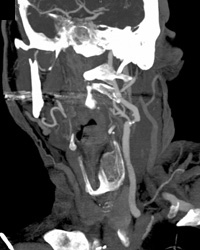 Carotid Artery Stenosis - CTisus CT Scan