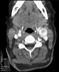 Enhancing Carotid Body Tumor (left) - CTisus CT Scan