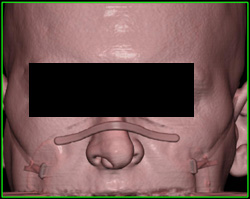 Facial Trauma - CTisus CT Scan