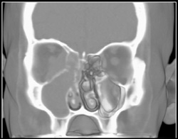 Orbital Fractures - CTisus CT Scan