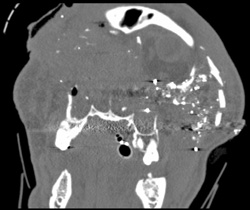 Gunshot Wound to Face With Multiple Fractures - CTisus CT Scan