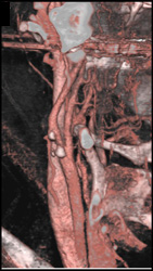 Calcified Plaque on Carotid Artery - CTisus CT Scan