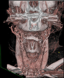 Normal Jugular Veins - CTisus CT Scan