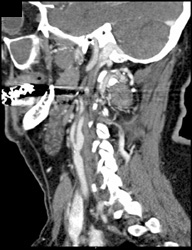 Carotid Artery Stenosis - CTisus CT Scan