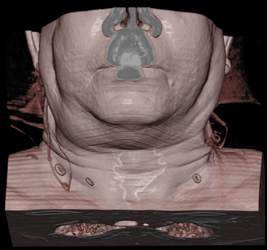 Mass in Right Submandibular Gland - CTisus CT Scan